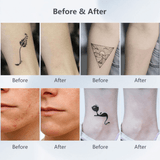 tattoo removal