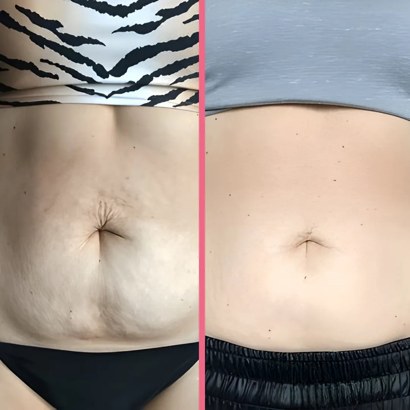 SculptPro™ 3-in-1 Skin Firming & Cellulite Massager