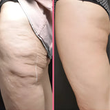 SculptPro™ 3-in-1 Skin Firming & Cellulite Massager