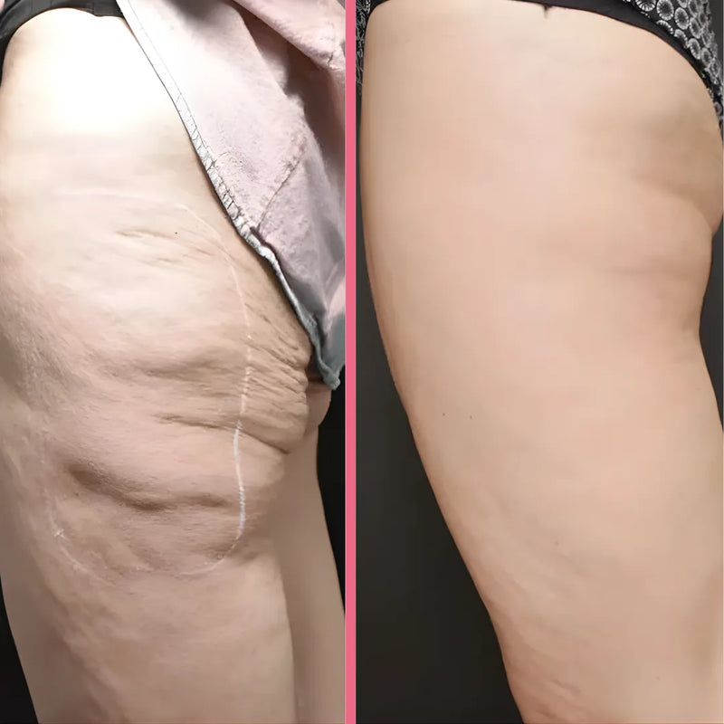 SculptPro™ 3-in-1 Skin Firming & Cellulite Massager